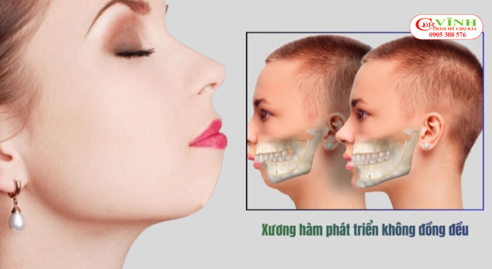 Trước và sau độn cằm lẹm - cằm lẹm là gì