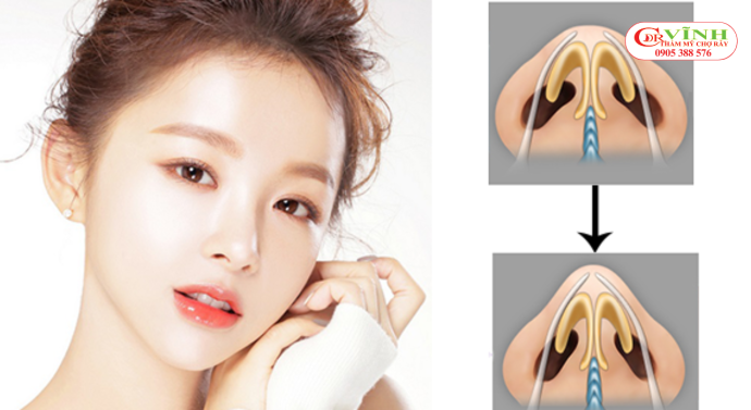 Nâng mũi sụn tai bao lâu thì lành