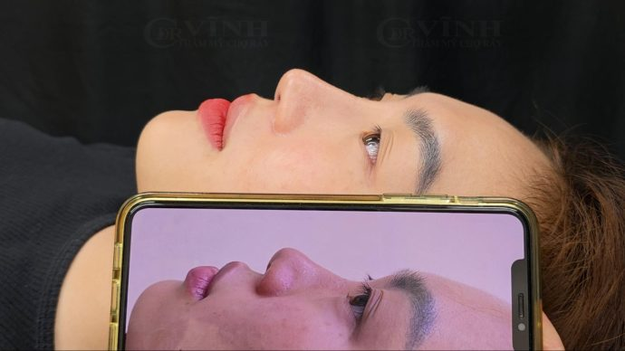 Nâng mũi sụn tai hình ảnh thực tế Bác sĩ Lê Hoàng Vĩnh - Chợ Rẫy