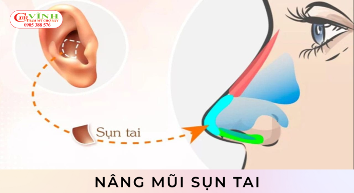 Nâng mũi sụn tai là gì