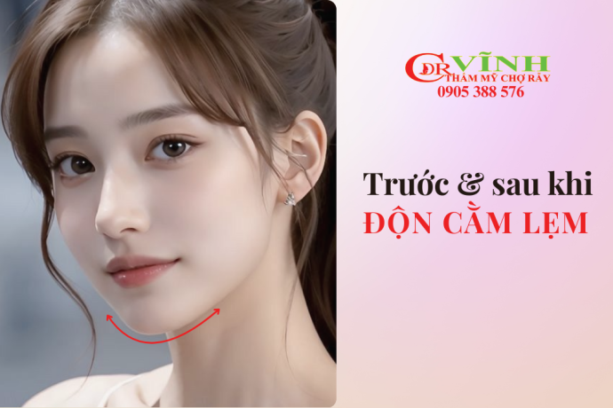 Trước và sau khi độn cằm lẹm