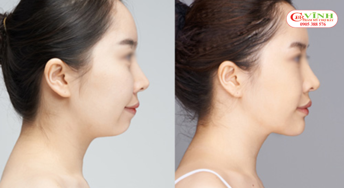 Trước và sau khi độn cằm lẹm bằng cách tiêm filler