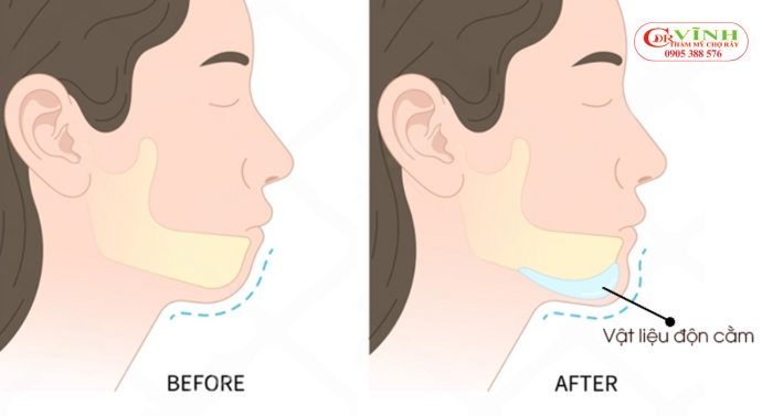 Trước và sau khi độn cằm lẹm bằng sụn nhân tạo