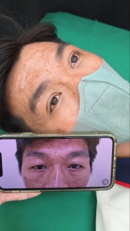 Cắt mí mini deep giá bao nhiêu? Cập nhật chi phí mới nhất Trước và sau khi cắt mí minideep tại Phòng khám Thẩm mỹ Tiến sĩ Vĩnh - Chợ Rẫy