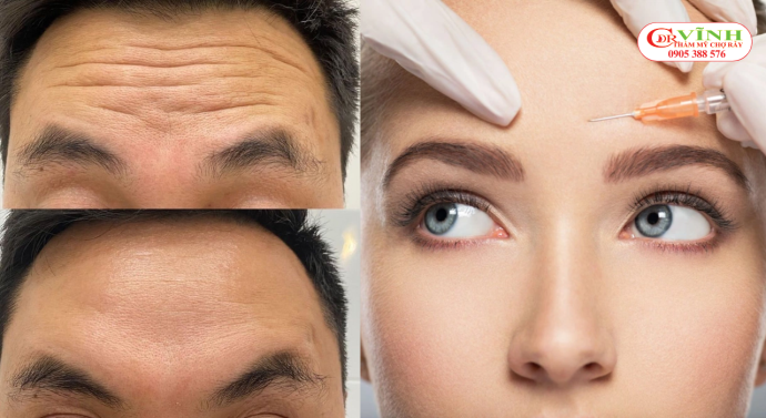 Tiêm botox xóa nhăn là gì? Ai phù hợp với phương pháp này? Ai phù hợp với tiêm botox xóa nhăn