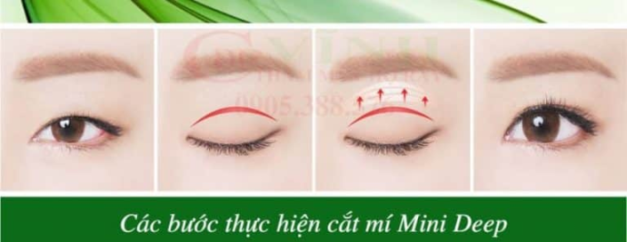 Cắt mí mini deep giá bao nhiêu? Cập nhật chi phí mới nhất Các bước thực hiện cắt mí minideep
