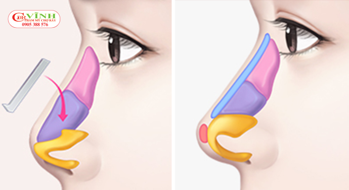 Các yếu tố cần xem xét khi xác định dáng mũi tự nhiên