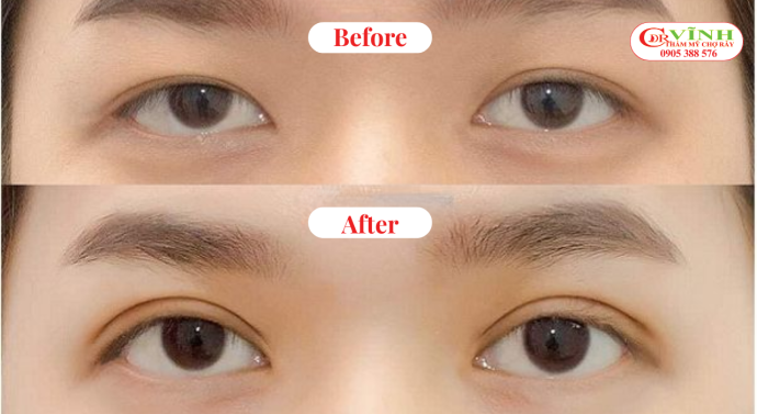 Cắt mí mini deep giá bao nhiêu? Cập nhật chi phí mới nhất Cắt mí minideep giá bao nhiêu? - những lưu ý tránh "giá rẻ rủi ro cao"