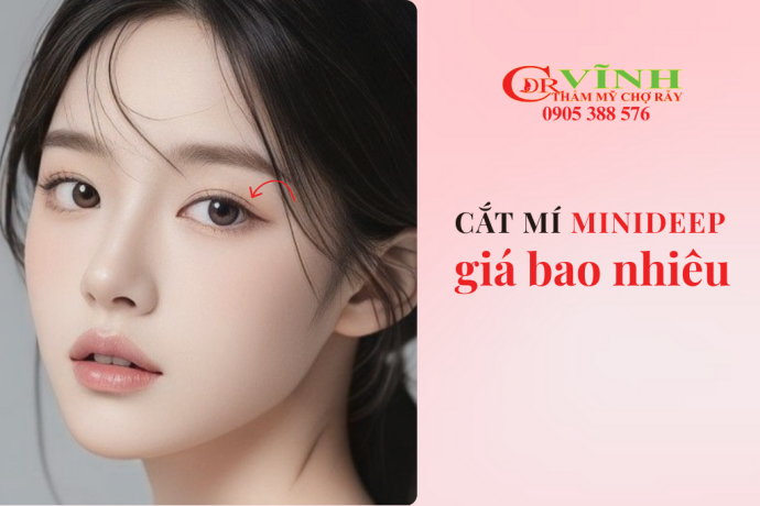 Cắt mí minideep giá bao nhiêu