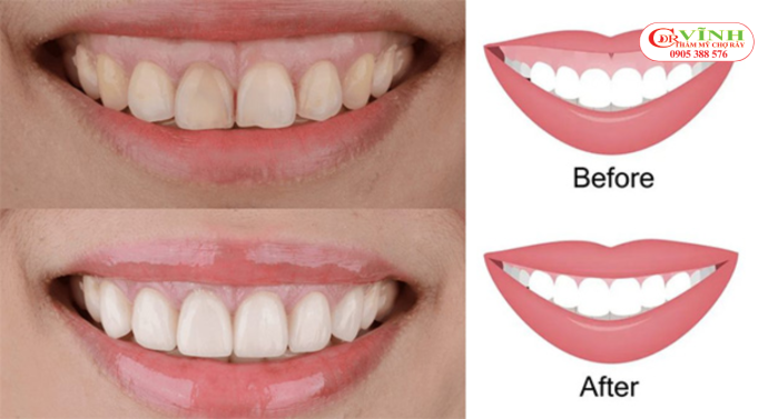 Điều trị cười hở lợi là gì? Ai phù hợp với phương pháp này? Chi phí điều trị cười hở lợi