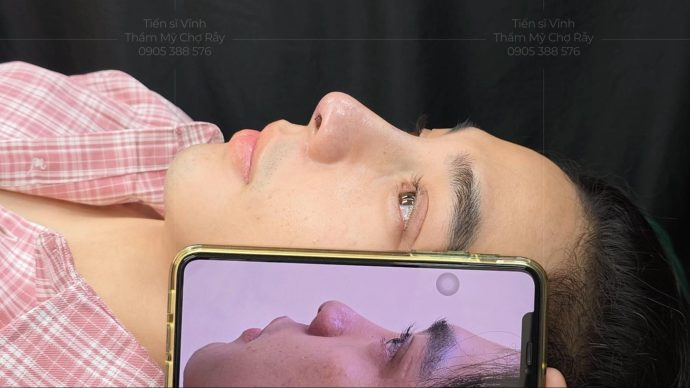 Dáng mũi tự nhiên cho nam Phòng khám Thẩm mỹ Tiến sĩ Vĩnh - Chợ Rẫy