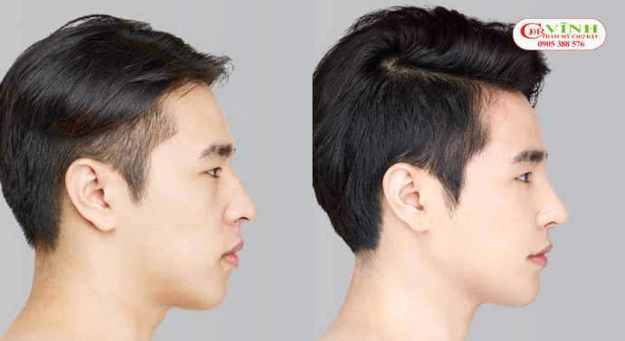 Dáng mũi tự nhiên nam giới