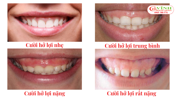 Điều trị cười hở lợi là gì? Ai phù hợp với phương pháp này? Điều trị cười hở lợi là gì và khi nào cần điều trị