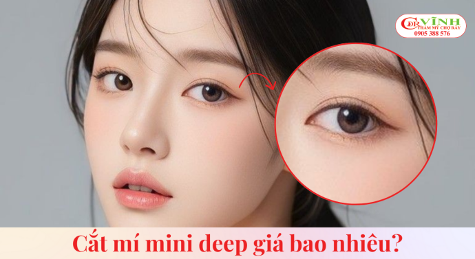 Cắt mí mini deep giá bao nhiêu? Cập nhật chi phí mới nhất Cắt mí minideep giá bao nhiêu