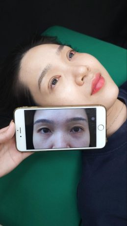 Cắt mí mini deep giá bao nhiêu? Cập nhật chi phí mới nhất Hình ảnh trước và sau khi cắt mí minideep tại Phòng khám Thẩm mỹ Tiến sĩ Vĩnh - Chợ Rẫy