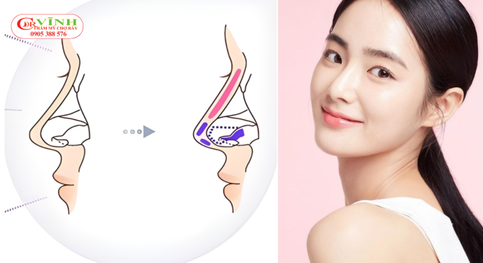 Nâng mũi sụn tự thân có phải tự nhiên nhất?