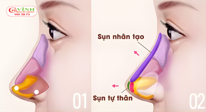 Nâng mũi sụn tự thân kết hợp sụn nhân tạo - sụn tai