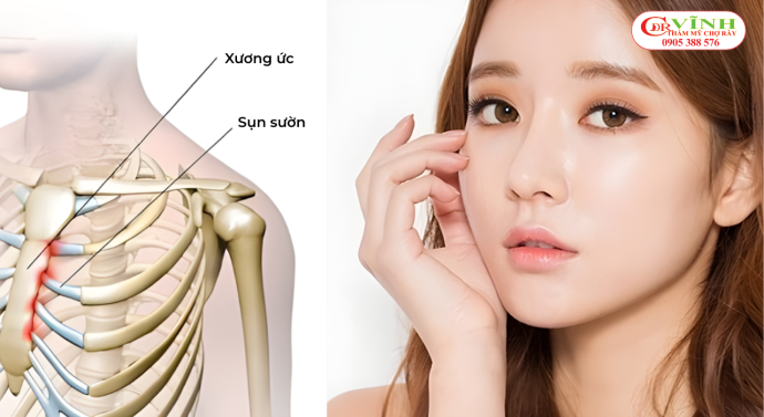 Nâng mũi sụn tự thân kết hợp sụn nhân tạo - sụn sườn