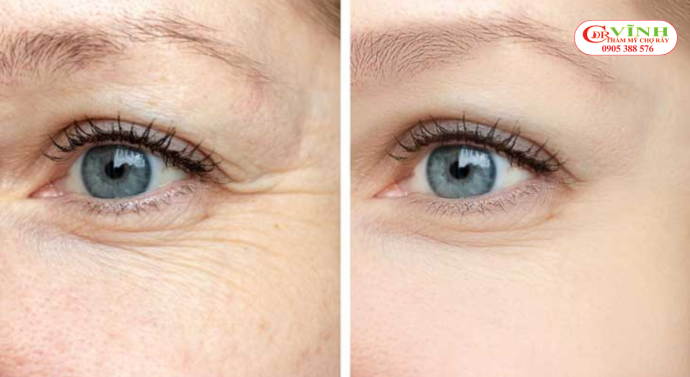 Tiêm botox xóa nhăn là gì? Ai phù hợp với phương pháp này? Tiêm botox xóa nhăn đuôi mắt