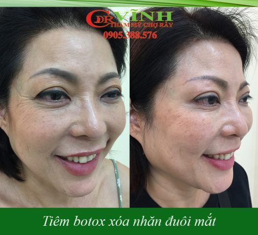 Tiêm botox xóa nhăn là gì? Ai phù hợp với phương pháp này? Trước và sau khi tiêm Botox xóa nhăn mắt tại Phòng khám Tiến sĩ Bác sĩ Lê Hoàng Vĩnh