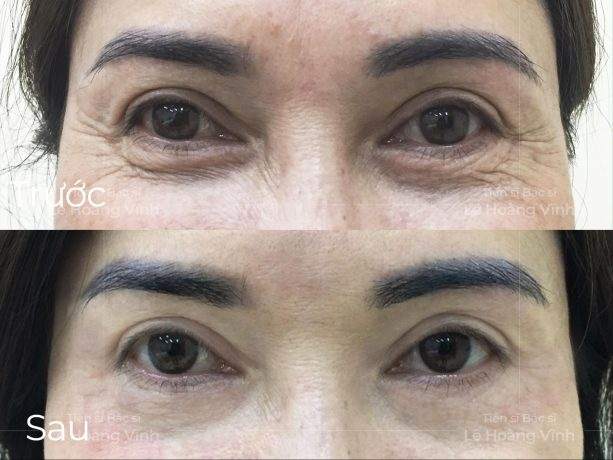 Tiêm botox xóa nhăn là gì? Ai phù hợp với phương pháp này? Trước và sau khi tiêm Botox xóa nhăn mắt tại Phòng khám Tiến sĩ Bác sĩ Lê Hoàng Vĩnh