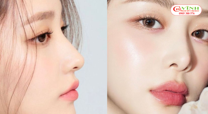 Sửa mũi bị lộ sống, đơ cứng: Nguyên nhân & cách khắc phục Cách khắc phục mũi bị lộ sống an toàn, tự nhiên