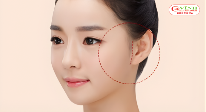 Căng da mặt mini có để lại sẹo không - đường mổ căng da mặt mini ở đâu