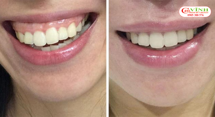 Điều trị cười hở lợi giá bao nhiêu - nguyên nhân cười hở lợi