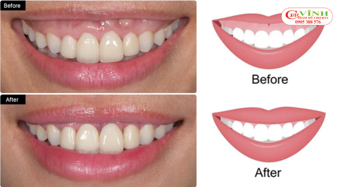 Giá điều trị cười hở lợi hiện nay