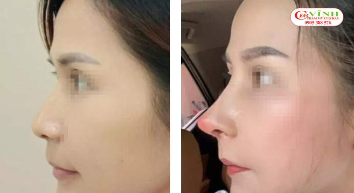 Sửa mũi bị lộ sống, đơ cứng: Nguyên nhân & cách khắc phục Nguyên nhân khiến mũi bị lộ sống sau nâng mũi