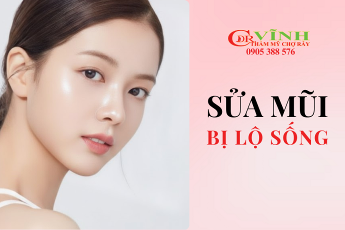 Sửa mũi bị lộ sống, đơ cứng: Nguyên nhân & cách khắc phục