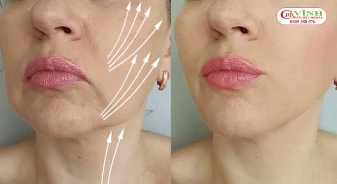 Căng da mặt mini có sẹo không - trẻ hóa da mặt sau khi căng da