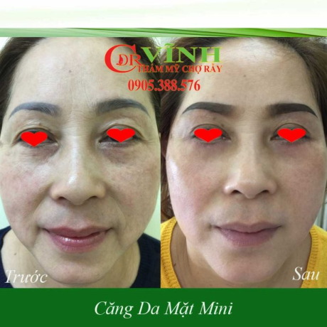 Trước và sau khi căng da mặt mini tại Phòng khám Thẩm mỹ Tiến sĩ Bác sĩ Lê Hoàng Vĩnh - Chợ Rẫy