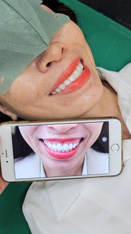 Trước và sau khi điều trị cười hở lợi tại Phòng khám Thẩm mỹ Tiến sĩ Lê Hoàng Vĩnh - Chợ Rẫy