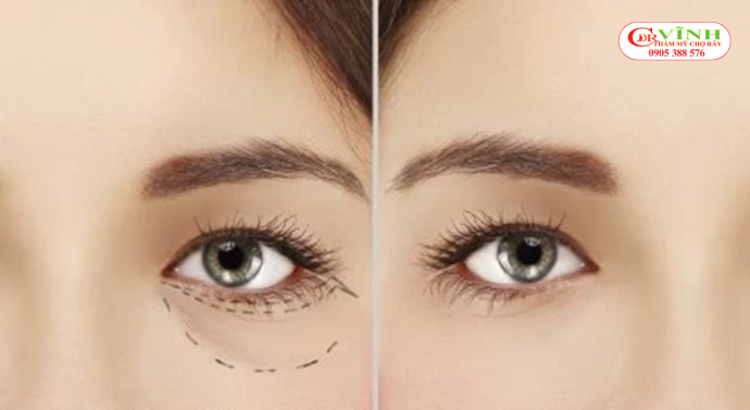 Các loại chi phí khi lấy mỡ bọng mắt