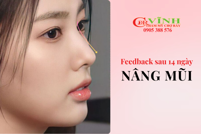 Feedback nâng mũi sau 14 ngày