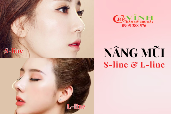 Nâng mũi S-line và L-line khác nhau thế nào