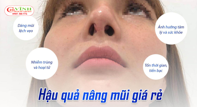 Những rủi ro khi nâng mũi giá rẻ có thể gặp phải