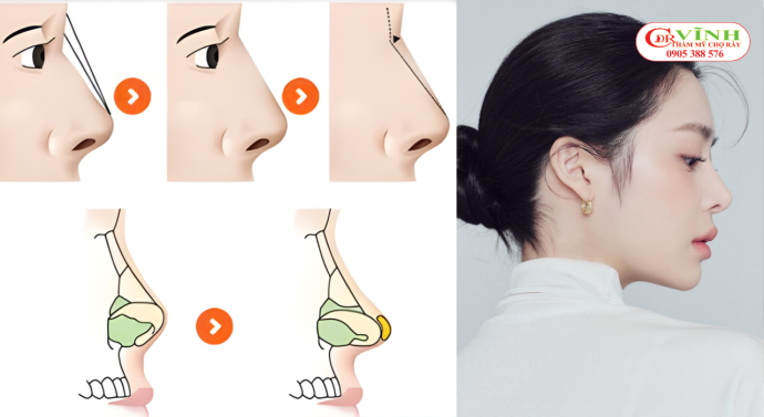 Yếu tố bác sĩ quyết định phần lớn thành công ca nâng mũi