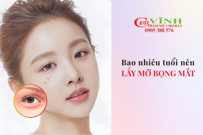 Bao nhiêu tuổi nên lấy mỡ bọng mắt? Bác sĩ giải đáp chi tiết