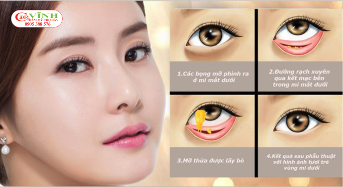 Bao nhiêu tuổi nên lấy mỡ bọng mắt - Độ tuổi ảnh hưởng như thế nào