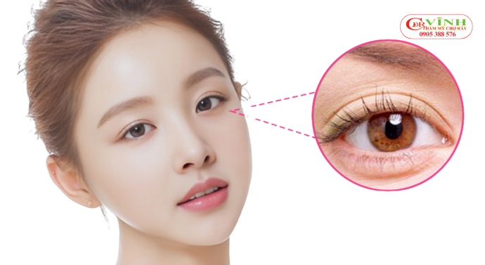 Bao nhiêu tuổi nên lấy mỡ bọng mắt là phù hợp