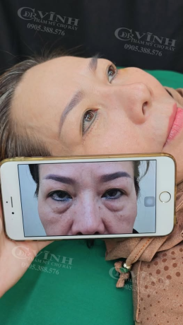 Befor After Lấy mỡ bọng mắt tại Thẩm mỹ viện Dr Vĩnh - Chợ Rẫy