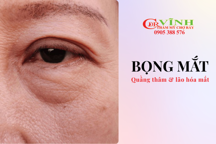 Bọng mắt là gì? Phân biệt bọng mỡ, quầng thâm và lão hóa vùng mắt
