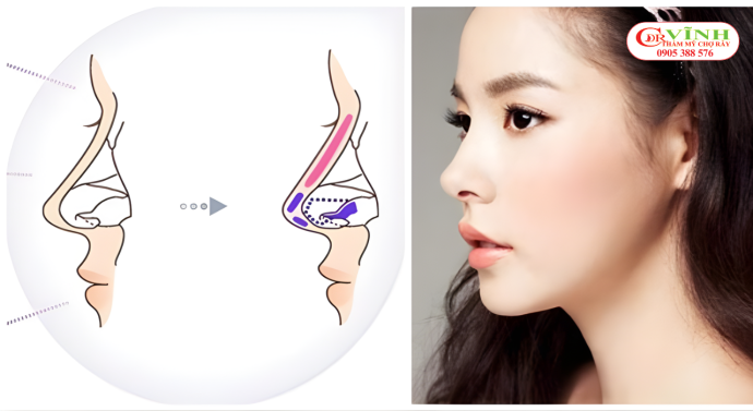 Mô phỏng cấu trúc mũi và phương pháp nâng mũi sụn giúp duy trì dáng mũi lâu dài