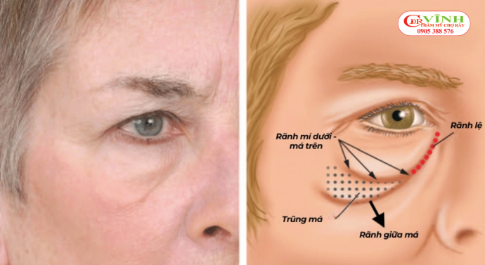 Cấu trúc giải phẫu đặc thù của vùng mí dưới