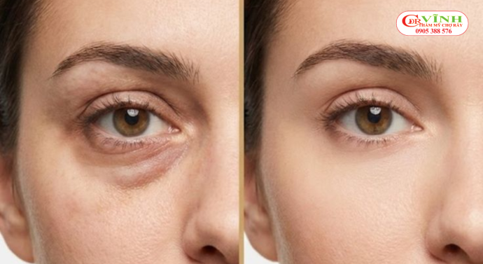 Có nên lấy mỡ bọng mắt không? Hiệu quả mang lại sau khi thực hiện