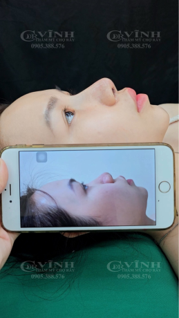 Khách hàng trước và sau nâng mũi với quá trình hồi phục an toàn và tự nhiên