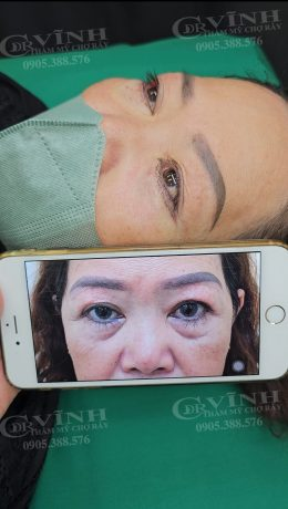 Kết quả lấy mỡ bọng mắt tự nhiên Tiến sĩ Bác sĩ Lê Hoàng Vĩnh - Chợ Rẫy