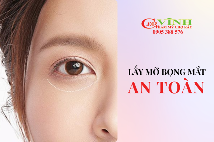 Lấy mỡ bọng mắt an toàn bởi Tiến sĩ Bác sĩ Lê Hoàng Vĩnh